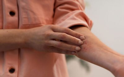 Diferencias entre picaduras de chinches y mosquitos